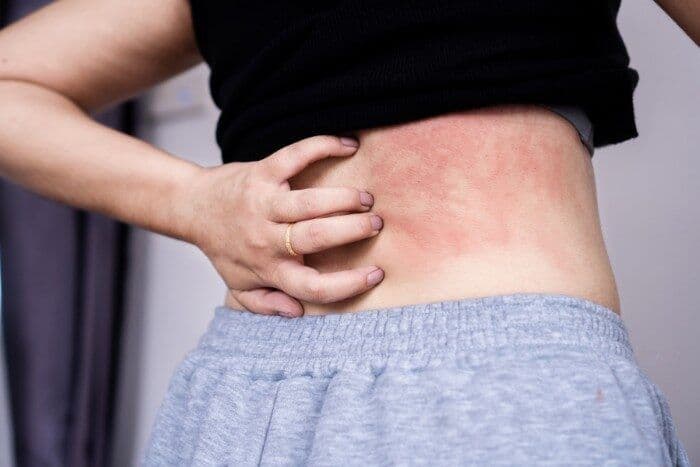 Hard water causing skin inflammation and discomfort