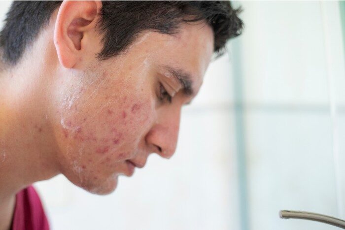 Acne on cheek with signs of dryness and flaking aggravated by Arizona hard water
