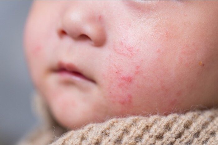 Baby with red eczema patches on cheeks, possibly worsened by hard water