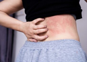 Hard water causing skin inflammation and discomfort