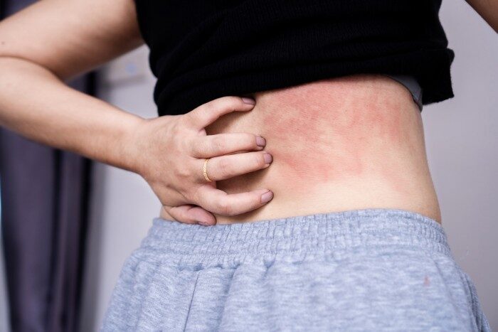 Hard water causing skin inflammation and discomfort