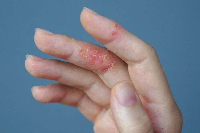 Severe eczema flare-up on fingers with peeling and redness