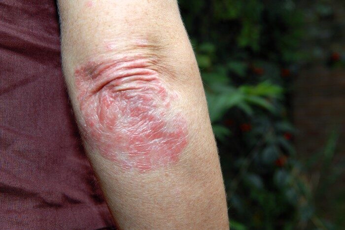 Psoriasis flare-up on elbow with dry, scaly skin
