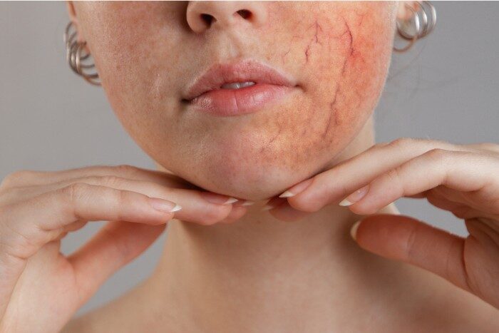 Rosacea inflammation on face worsened by water quality