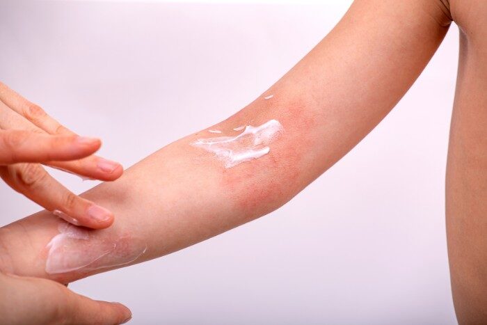 Applying cream to irritated skin affected by Arizona hard water